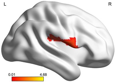 Brain alterations in adolescents with first-episode depression who have experienced adverse events: evidence from resting-state functional magnetic resonance imaging